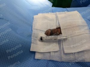 Tăng kích thước dương vật bằng megaderm, đường mổ ở mu, khách hàng 47 tuổi, HCM - ca 143