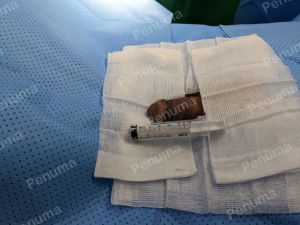 Tăng kích thước dương vật bằng megaderm, đường mổ ở mu, khách hàng 47 tuổi, HCM - ca 143