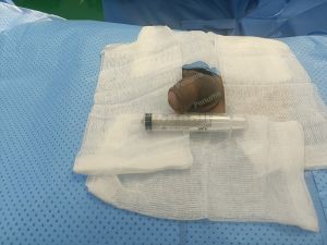 Tăng kích thước cậu nhỏ bằng tấm độn megaderm, đường mổ ở mu, khách hàng 30 tuổi, Long An - ca 147