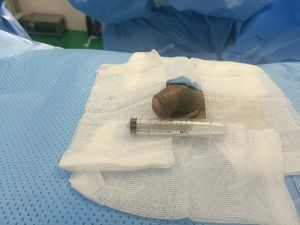 Tăng kích thước cậu nhỏ bằng tấm độn megaderm, đường mổ ở mu, khách hàng 30 tuổi, Long An - ca 147