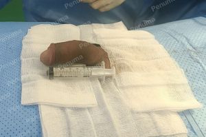 Tăng kích thước cậu nhỏ bằng tấm độn megaderm, đường mổ ở mu, khách hàng 30 tuổi, Long An - ca 147