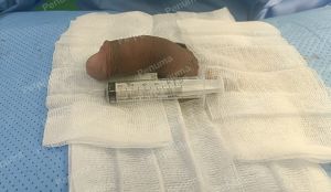 Tăng kích thước cậu nhỏ bằng tấm độn megaderm, đường mổ ở mu, khách hàng 30 tuổi, Long An - ca 147