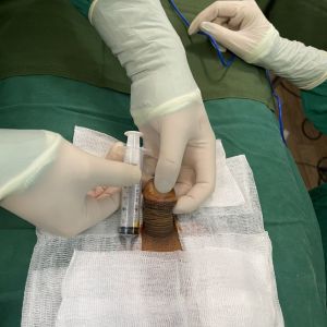 Độn dương vật bằng mô da nhân tạo, đường mổ ở mu, khách hàng 32 tuổi, Thái Nguyên - ca 148