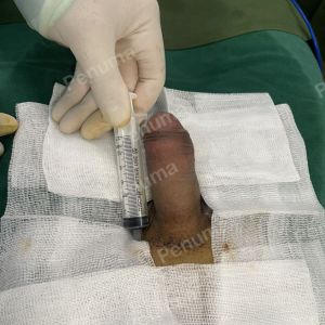 Độn dương vật bằng mô da nhân tạo, đường mổ ở mu, khách hàng 32 tuổi, Thái Nguyên - ca 148