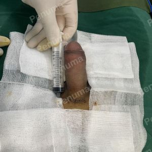 Độn dương vật bằng mô da nhân tạo, đường mổ ở mu, khách hàng 32 tuổi, Thái Nguyên - ca 148