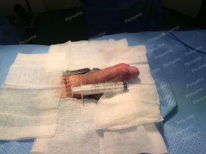 Độn dương vật bằng mô da nhân tạo, đường mổ ở mu, khách hàng 30 tuổi, HCM - ca 152