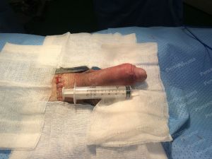 Độn dương vật bằng mô da nhân tạo, đường mổ ở mu, khách hàng 30 tuổi, HCM - ca 152