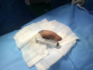 Độn dương vật bằng mô da nhân tạo, đường mổ ở mu, khách hàng 30 tuổi, HCM - ca 152