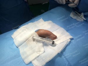 Độn dương vật bằng mô da nhân tạo, đường mổ ở mu, khách hàng 30 tuổi, HCM - ca 152