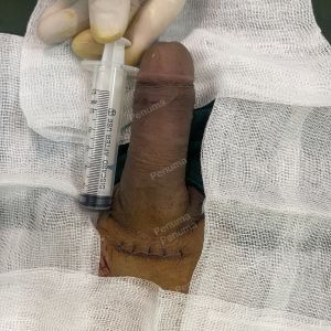 Độn dương vật bằng tấm độn megaderm, đường mổ ở mu, khách hàng 40 tuổi, Lạng Sơn - ca 156