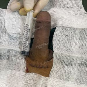 Độn dương vật bằng tấm độn megaderm, đường mổ ở mu, khách hàng 40 tuổi, Lạng Sơn - ca 156