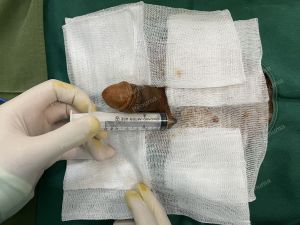 Tăng kích thước cậu nhỏ bằng tấm độn sinh học megaderm, đường mổ ở mu, khách hàng 31 tuổi, Hà Nội - ca 153