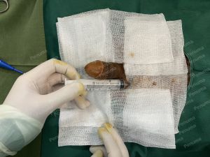 Tăng kích thước cậu nhỏ bằng tấm độn sinh học megaderm, đường mổ ở mu, khách hàng 31 tuổi, Hà Nội - ca 153