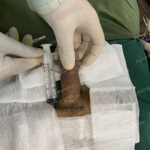 Tăng kích thước cậu nhỏ bằng tấm độn sinh học megaderm, đường mổ ở mu, khách hàng 31 tuổi, Hà Nội - ca 153