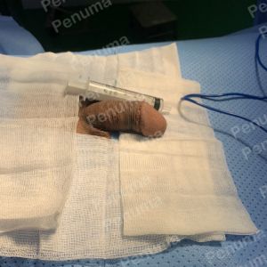 Độn dương vật bằng tấm độn sinh học, đường mổ ở mu, khách hàng 41 tuổi, HCM - ca 157