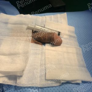 Độn dương vật bằng tấm độn sinh học, đường mổ ở mu, khách hàng 41 tuổi, HCM - ca 157