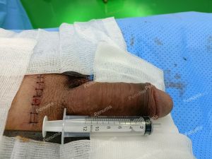 Độn dương vật bằng tấm độn sinh học, đường mổ ở mu, khách hàng 41 tuổi, HCM - ca 157