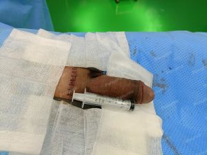 Độn dương vật bằng tấm độn sinh học, đường mổ ở mu, khách hàng 41 tuổi, HCM - ca 157