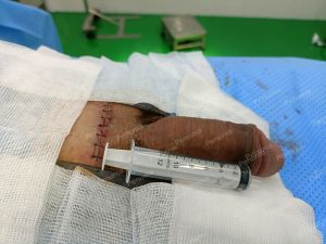 Độn dương vật bằng tấm độn sinh học, đường mổ ở mu, khách hàng 41 tuổi, HCM - ca 157