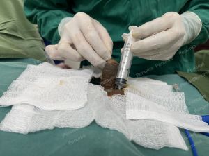 Độn dương vật bằng mô da nhân tạo, đường mổ ở mu, khách hàng 43 tuổi, Ninh Bình - ca 154