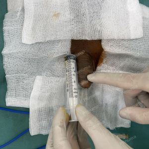 Độn dương vật bằng mô da nhân tạo, đường mổ ở mu, khách hàng 43 tuổi, Ninh Bình - ca 154