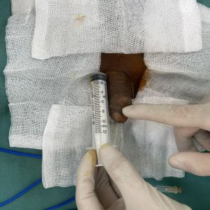 Độn dương vật bằng mô da nhân tạo, đường mổ ở mu, khách hàng 43 tuổi, Ninh Bình - ca 154