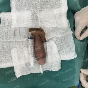 Độn dương vật bằng mô da nhân tạo, đường mổ ở mu, khách hàng 43 tuổi, Ninh Bình - ca 154