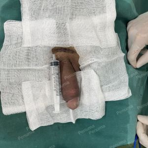 Độn dương vật bằng mô da nhân tạo, đường mổ ở mu, khách hàng 43 tuổi, Ninh Bình - ca 154