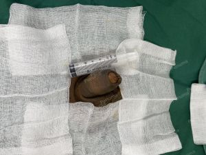 Tăng kích thước dương vật bằng megaderm, đường mổ ở mu, khách hàng 45 tuổi, Hà Nội - ca 155