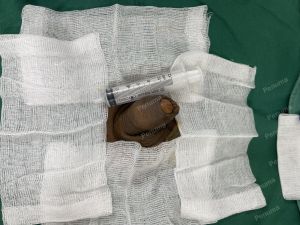 Tăng kích thước dương vật bằng megaderm, đường mổ ở mu, khách hàng 45 tuổi, Hà Nội - ca 155