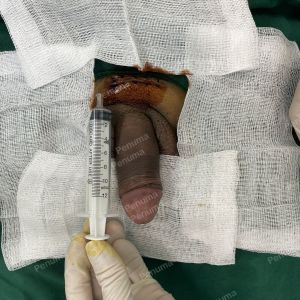 Tăng kích thước dương vật bằng megaderm, đường mổ ở mu, khách hàng 45 tuổi, Hà Nội - ca 155