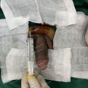 Tăng kích thước dương vật bằng megaderm, đường mổ ở mu, khách hàng 45 tuổi, Hà Nội - ca 155