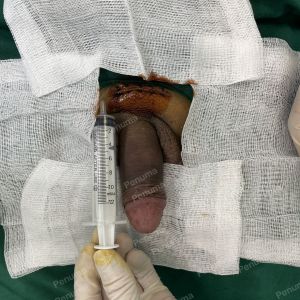 Tăng kích thước dương vật bằng megaderm, đường mổ ở mu, khách hàng 45 tuổi, Hà Nội - ca 155