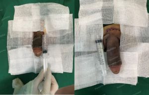 Độn dương vật bằng megaderm, đường mổ ở mu, khách hàng 40 tuổi, Ninh Bình- ca 160