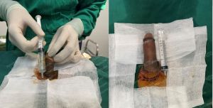 Độn dương vật bằng tấm độn sinh học, đường mổ ở mu, khách hàng 45 tuổi, Hà Nội - ca 165