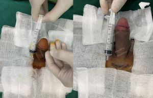 Tăng kích thước dương vật bằng tấm độn sinh học megaderm, đường mổ ở mu, khách hàng 35 tuổi, Hưng Yên - ca 167