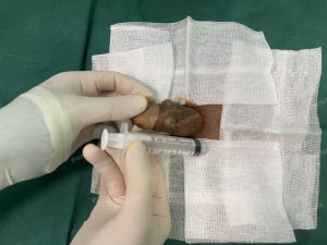 Độn dương vật bằng tấm độn megaderm, đường mổ ở mu, khách hàng 42 tuổi, Hưng Yên - ca 168