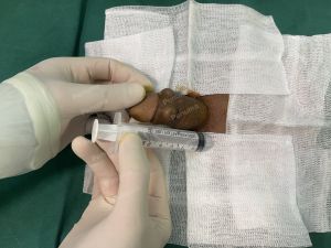 Độn dương vật bằng tấm độn megaderm, đường mổ ở mu, khách hàng 42 tuổi, Hưng Yên - ca 168