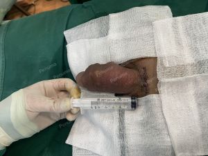 Độn dương vật bằng tấm độn megaderm, đường mổ ở mu, khách hàng 42 tuổi, Hưng Yên - ca 168