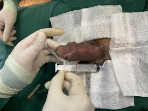 Độn dương vật bằng tấm độn megaderm, đường mổ ở mu, khách hàng 42 tuổi, Hưng Yên - ca 168