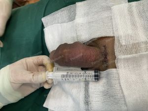 Độn dương vật bằng tấm độn megaderm, đường mổ ở mu, khách hàng 42 tuổi, Hưng Yên - ca 168