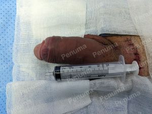 Tăng kích thước dương vật bằng tấm độn sinh học megaderm, đường mổ ở mu, khách hàng 39 tuổi, Vũng Tàu - ca 159