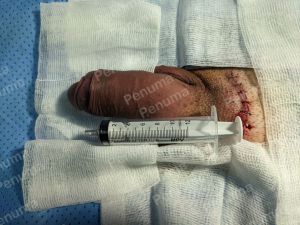 Tăng kích thước dương vật bằng tấm độn sinh học megaderm, đường mổ ở mu, khách hàng 39 tuổi, Vũng Tàu - ca 159