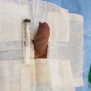 Tăng kích thước dương vật bằng tấm độn sinh học megaderm, đường mổ ở mu, khách hàng 39 tuổi, Vũng Tàu - ca 159