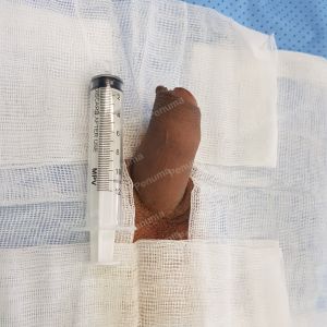 Tăng kích thước dương vật bằng tấm độn sinh học megaderm, đường mổ ở mu, khách hàng 39 tuổi, Vũng Tàu - ca 159