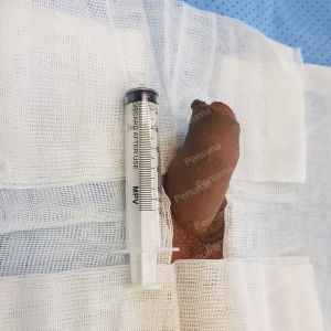 Tăng kích thước dương vật bằng tấm độn sinh học megaderm, đường mổ ở mu, khách hàng 39 tuổi, Vũng Tàu - ca 159