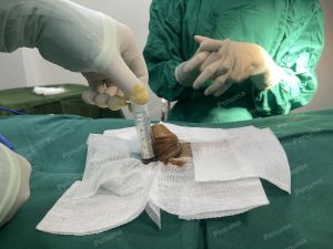 Tăng kích thước dương vật bằng tấm độn sinh học megaderm, đường mổ ở mu, khách hàng 34 tuổi, Bắc Ninh - ca 163