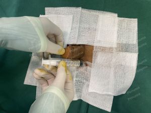 Tăng kích thước dương vật bằng tấm độn sinh học megaderm, đường mổ ở mu, khách hàng 34 tuổi, Bắc Ninh - ca 163