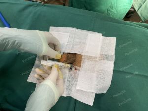 Tăng kích thước dương vật bằng tấm độn sinh học megaderm, đường mổ ở mu, khách hàng 34 tuổi, Bắc Ninh - ca 163