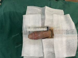 Tăng kích thước dương vật bằng tấm độn sinh học megaderm, đường mổ ở mu, khách hàng 34 tuổi, Bắc Ninh - ca 163